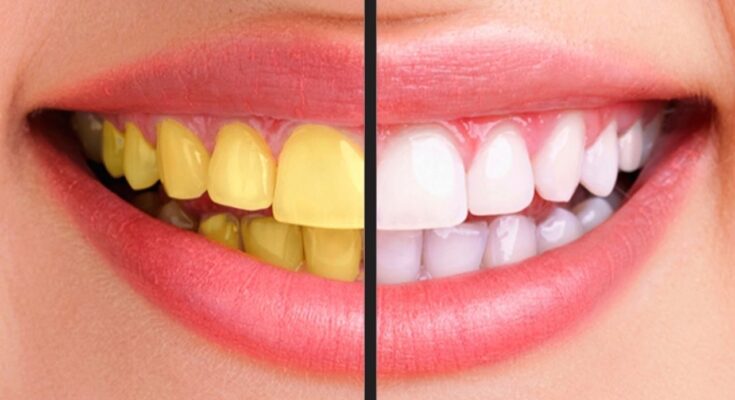 पीले दांतों को दूध जैसा सफेद कर देगा ये सबसे आसान घरेलू उपाय, अवश्य प्रयोग करें